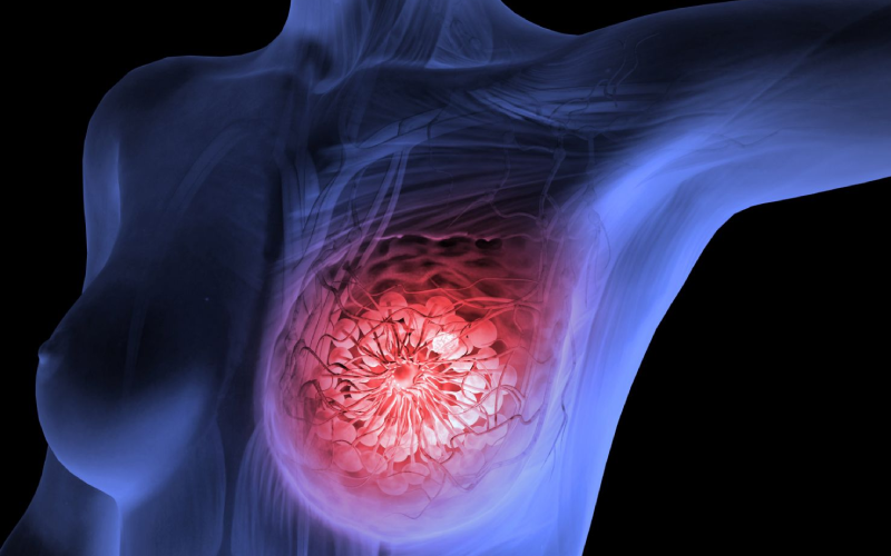 Understanding Breast Cancer