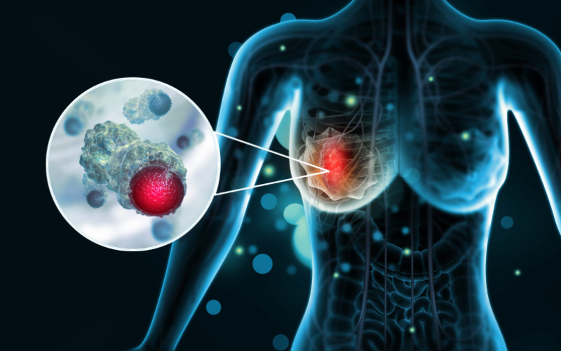 Breast Cancer Overview