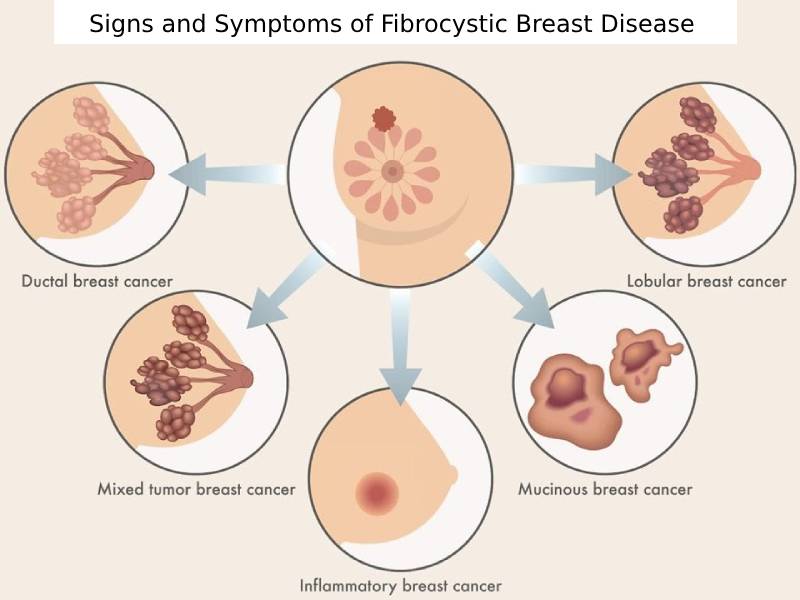 Signs and Symptoms of Fibrocystic Breast Disease