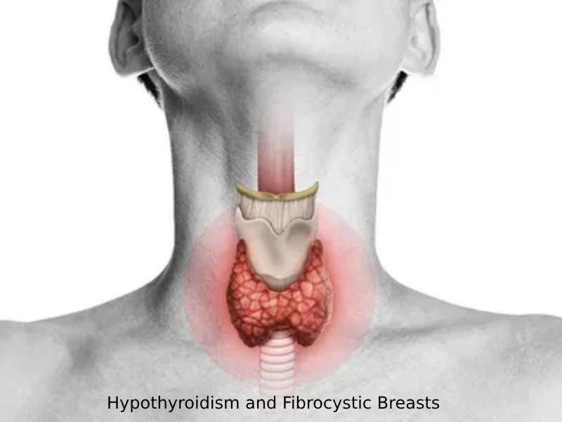 Hypothyroidism and Fibrocystic Breasts