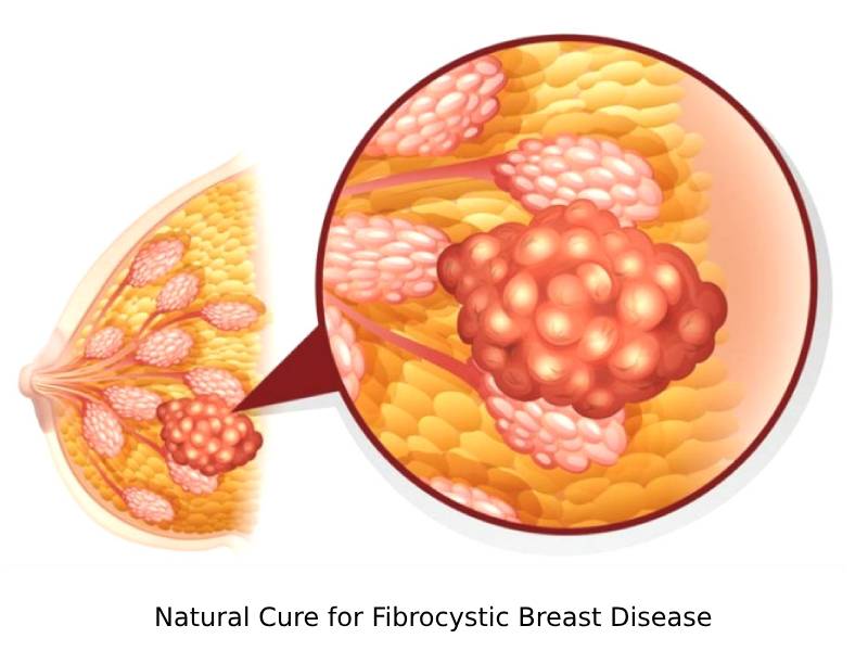 Natural Cure for Fibrocystic Breast Disease